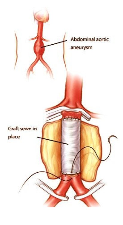 Abdominal Aortic Aneurysm Aaa Vascular One 4779